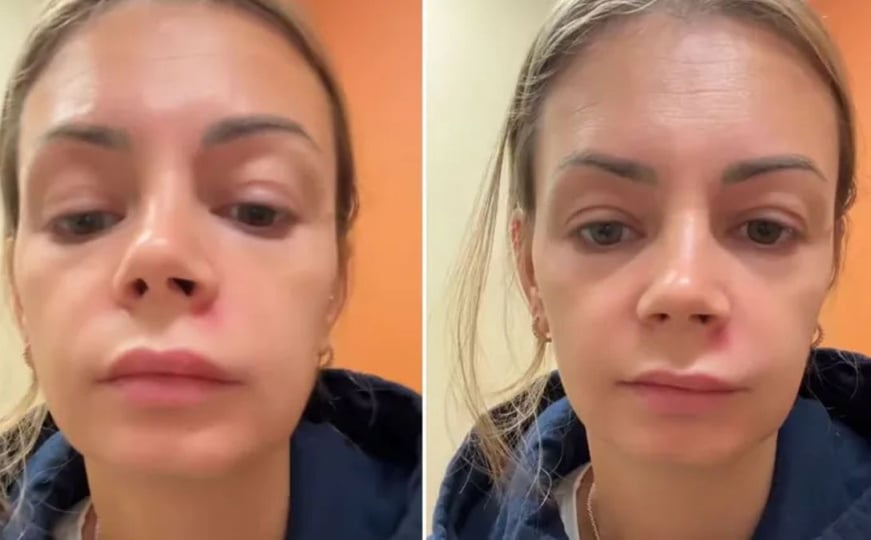 Istiskala bubuljicu, pa joj se paraliziralo lice: Ni slučajno ne dirajte ‘Trokut smrti’ ovo malo ko zna, nemojte napraviti istu grešku! - featured image Istiskala bubuljicu, pa joj se paraliziralo lice: Ni slučajno ne dirajte ‘Trokut smrti’ ovo malo ko zna, nemojte napraviti istu grešku! - featured image